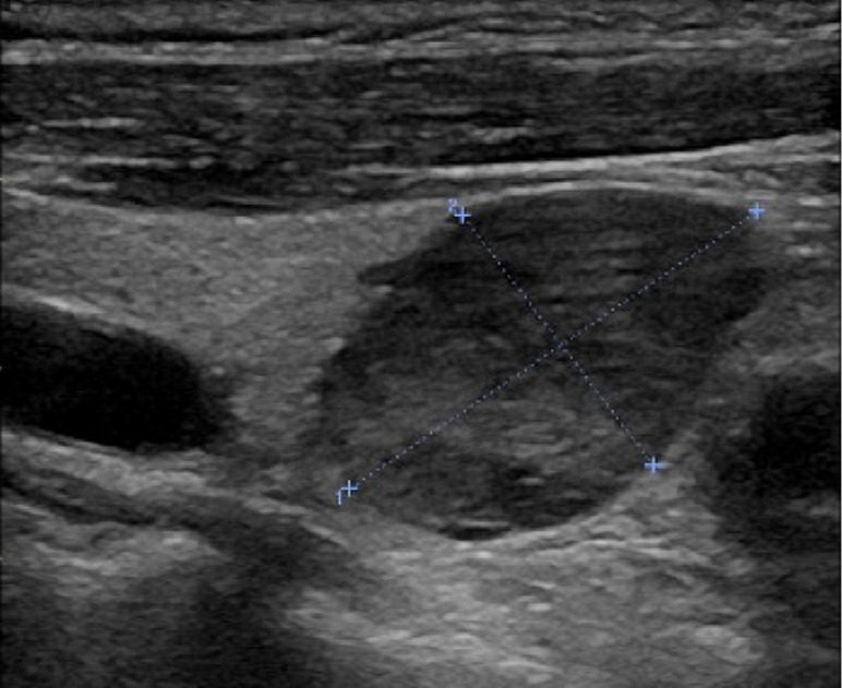 Potential higher malignancy of nonfunctional parathyroid carcinoma: a case series study.