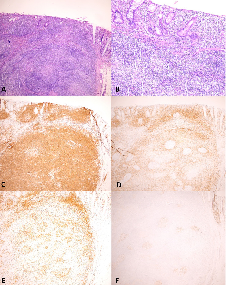 A 12 mm-sized rectal subepithelial tumor: uncommon, but one you must know.