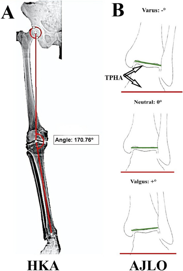 Assessment and quantification of ipsilateral and contralateral ankle joint alignment changes after unilateral total knee arthroplasty for knee osteoarthritis with varus deformity: a retrospective cohort study.