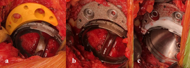 The use of porous titanium acetabular augments in primary total hip arthroplasty for hip dysplasia or rapidly destructive coxopathy.