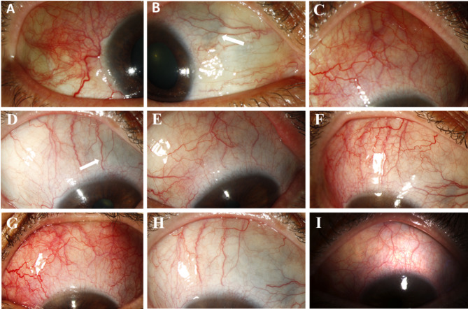 Subconjunctival dexamethasone implant (Ozurdex<sup>®</sup>) in the management of refractory Non-Infectious anterior scleritis.