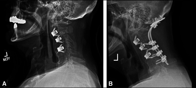 Three-Dimensional Printed Anterior Cervical Standalone Combined Cage-Plate-300 Consecutive Medical Implants.