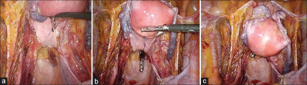Comparative Long-term Outcomes of Laparoscopic Radical Hysterectomy with Sentinel Node Navigation and Open Surgery for Cervical Cancer.
