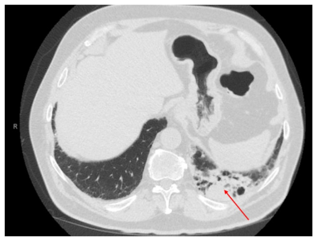 Case With Refractory Myasthenia Gravis Caused by Pembrolizumab.