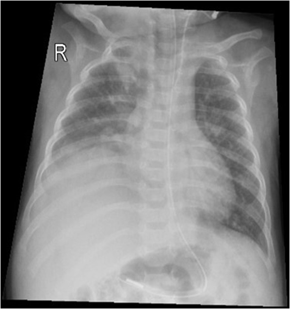 Diaphragmatic Paralysis Following Chest Tube Insertion in an Infant: <i>Case report and literature review</i>.