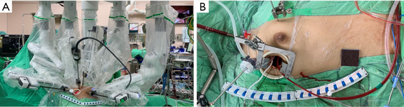 Outcomes of robotic and endoscopic combined aortic and mitral valve surgery: experience from National Taiwan University Hospital.