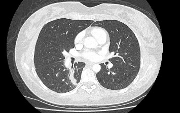 Beating the Odds: A Successful Pregnancy in a Patient With ALK-Rearranged Lung Cancer on Alectinib.