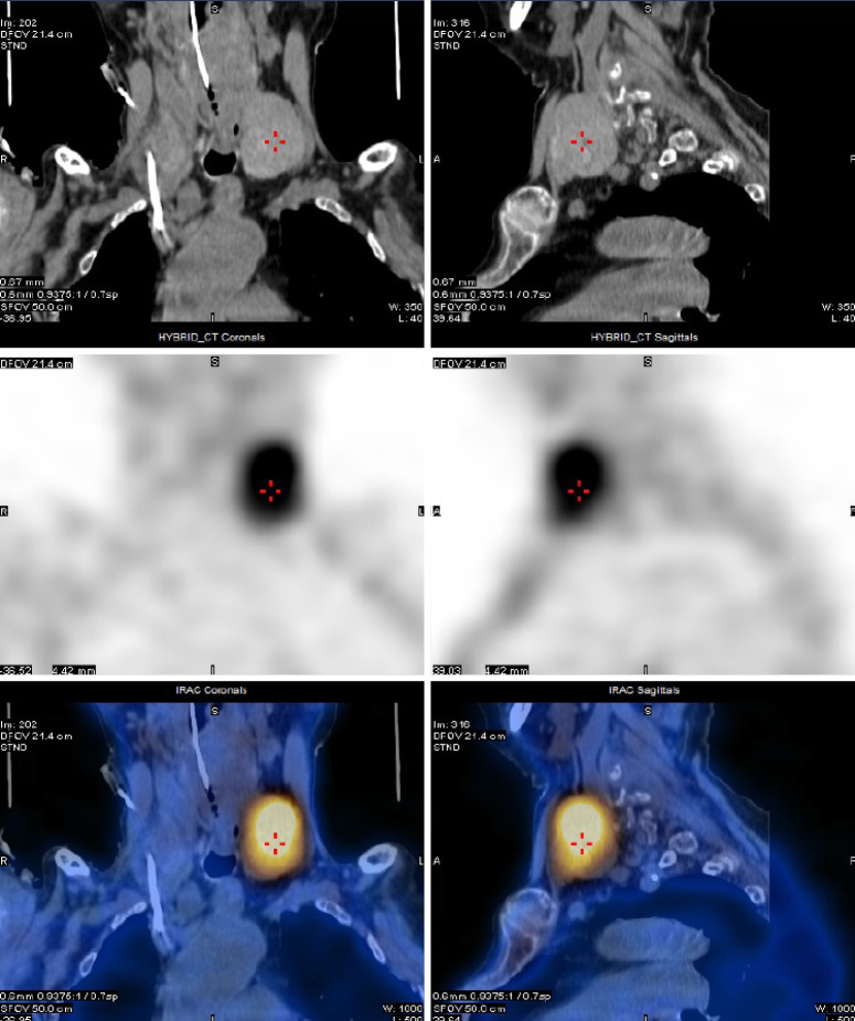 Potential higher malignancy of nonfunctional parathyroid carcinoma: a case series study.