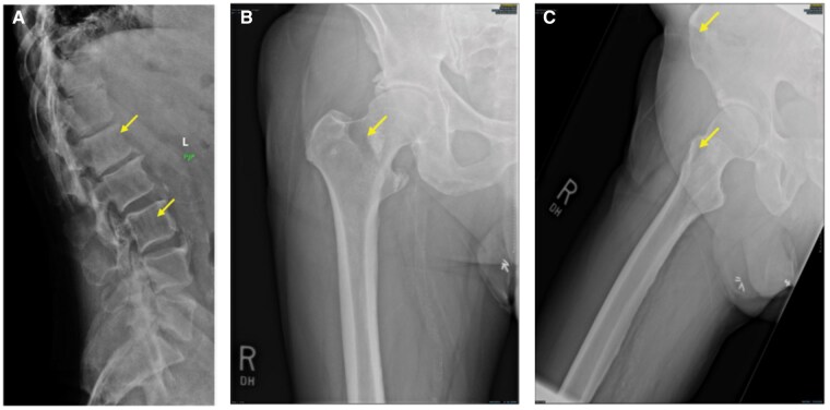 Whole-body MRI for a patient with progressive multiple myeloma.
