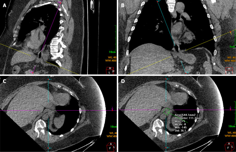 Association of esophageal hiatus size with reflux esophagitis and type I hiatal hernia in patients with obesity.