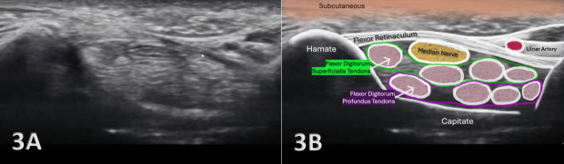 Diagnostic Musculoskeletal Ultrasound in the Evaluation of the Median Nerve.
