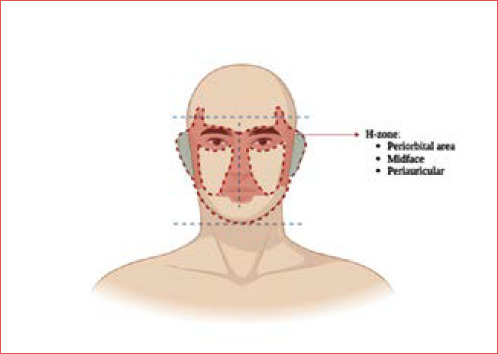 Margins in head and neck non-melanoma skin cancer surgery: clinical/pathological criteria and their impact on oncological outcomes and therapeutic choices. A systematic review.