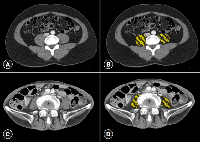Influence of sarcopenia on clinical outcomes in peptic ulcer bleeding: a retrospective single-center analysis in Korea.
