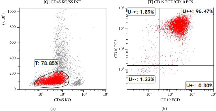 Unusual Presentation of Childhood Leukemia With Vaginal Bleeding: A Case Report.