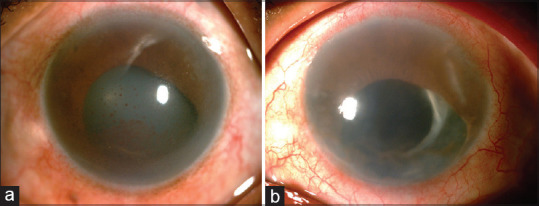 Polymerase chain reaction in viral anterior uveitis with secondary glaucoma: Analysis of 28 eyes from a tertiary eye care center in South India.