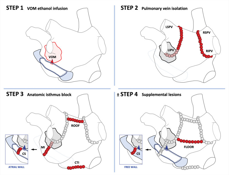 Marshall-Plan Ablation Strategy Versus Pulmonary Vein Isolation in Persistent AF: A Randomized Controlled Trial.