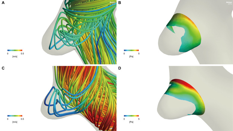 Comparison of ELAPSS Score and Computational Fluid Dynamics for Predicting Growth of Small Unruptured Cerebral Aneurysms.