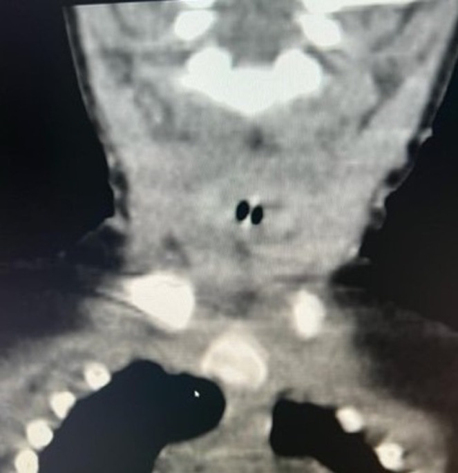 [Impacted subglottic fish vertebra in an infant: an unusual case report].