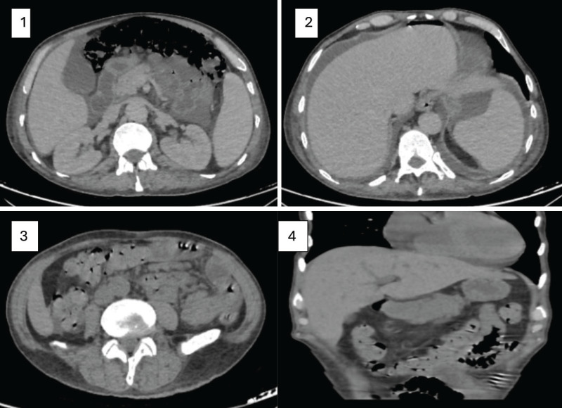 What Happened Suddenly - Acute Abdomen? A Difficult Case of ATRA-Related Pneumatosis Cystoides Intestinalis