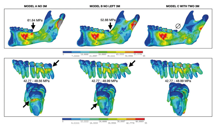 The interaction between third molars and surrounding periapical tissues in mandibular stress distribution during high-impact trauma: a finite element study.