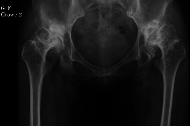 The use of porous titanium acetabular augments in primary total hip arthroplasty for hip dysplasia or rapidly destructive coxopathy.