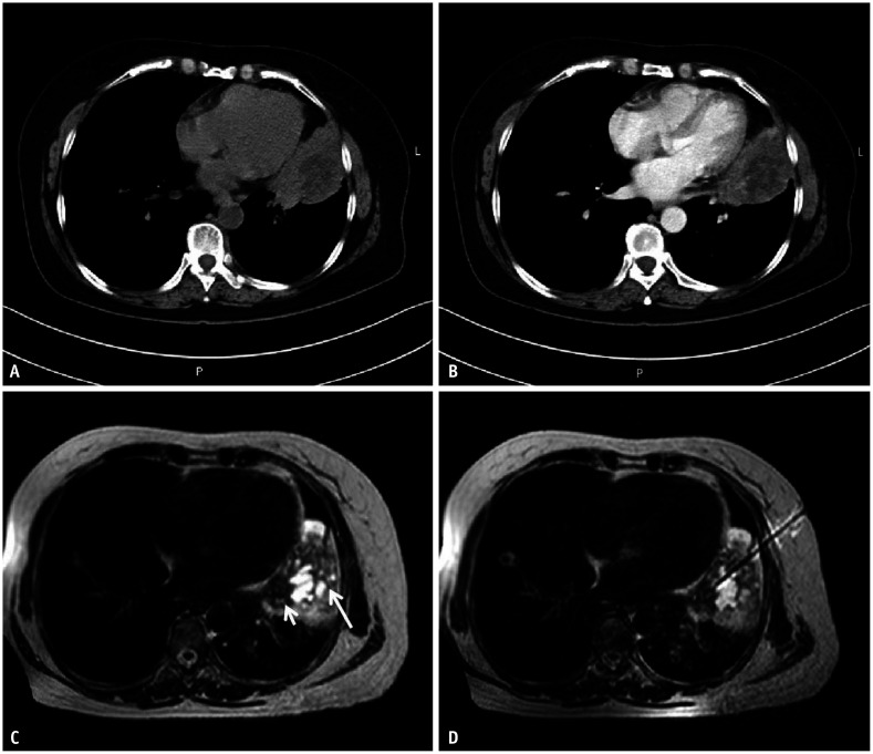 Feasibility of Multiparameter MRI-Guided Percutaneous Biopsy for Central Lung Lesions With Atelectasis.