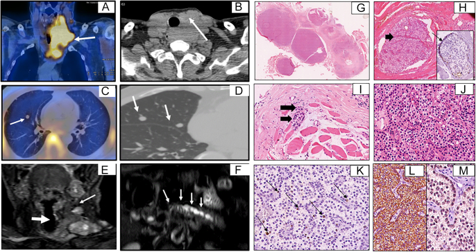 Malignant transformation of parathyromatosis to parathyroid carcinoma with invasive growth and distant metastasis.