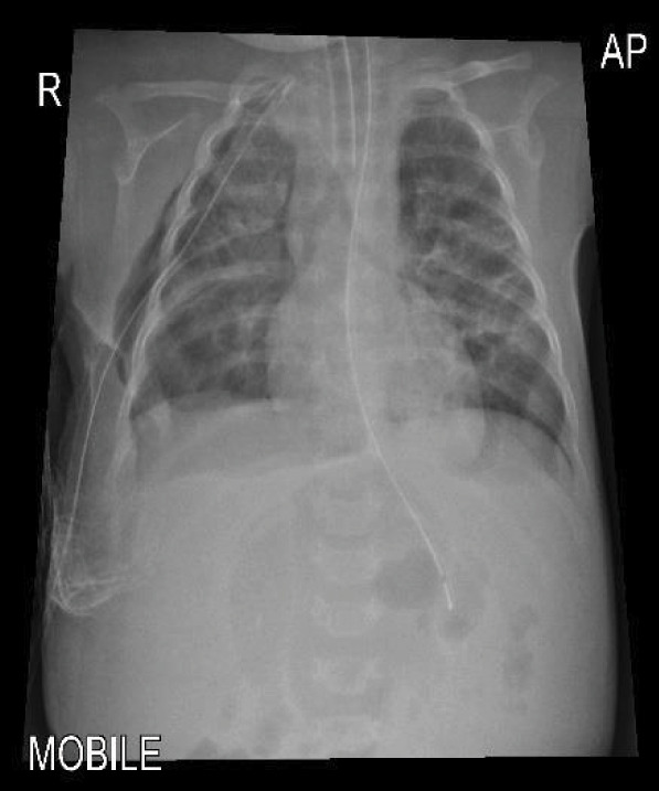 Diaphragmatic Paralysis Following Chest Tube Insertion in an Infant: <i>Case report and literature review</i>.
