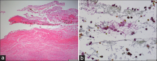 Four cases of endogenous <i>Klebsiella</i> endophthalmitis in Los Angeles County: A case series.
