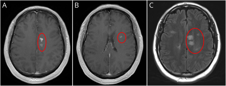 "Will the Real Demyelinating Disorder Please Stand Up?": From the National Multiple Sclerosis Society Case Conference Proceedings.
