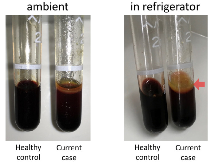 Fatty Precipitation in Donor Bone Marrow Caused by Overnight Cold Preservation in a Refrigerator
