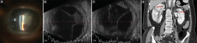 Four cases of endogenous <i>Klebsiella</i> endophthalmitis in Los Angeles County: A case series.