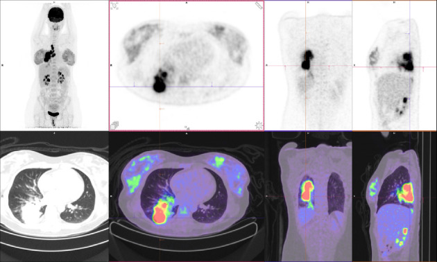 Beating the Odds: A Successful Pregnancy in a Patient With ALK-Rearranged Lung Cancer on Alectinib.