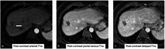 Accuracy of cross-sectional imaging in predicting tumor viability using the LI-RADS treatment response algorithm after image-guided percutaneous ablation with radiologic-pathologic explant correlation.