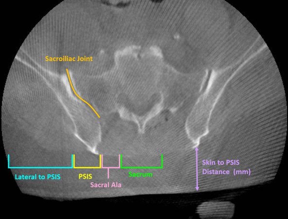 Accuracy of posterosuperior iliac spine reference array placement in robot-navigated spine surgery.