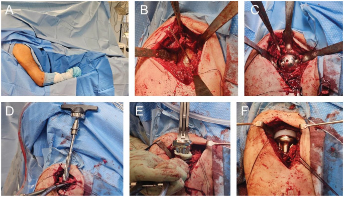 Prosthetic treatment of proximal humerus fractures in the elderly.