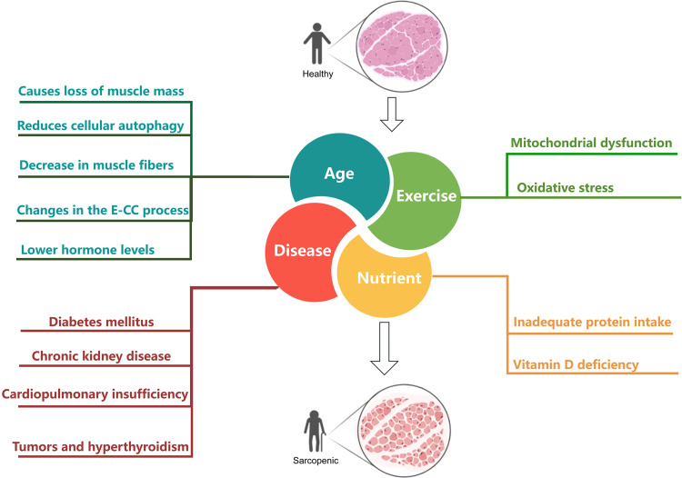 Exploration of Pathogenesis and Cutting-Edge Treatment Strategies of Sarcopenia: A Narrative Review.