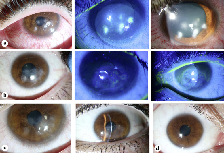 Fungal Keratitis following the Application of Green Tea Bag Warm Compresses.