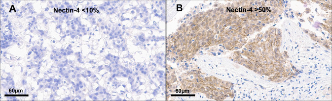 Effects of pregnancy on breast cancer immunology: immune biomarker and TIL quantification.