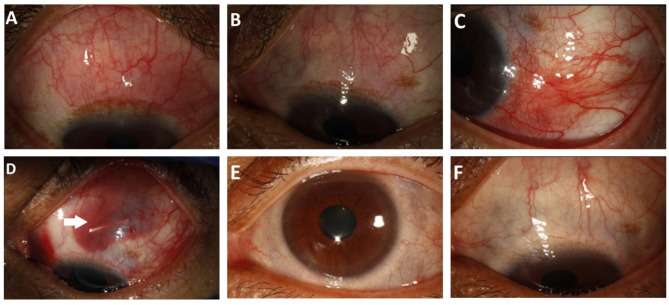 Subconjunctival dexamethasone implant (Ozurdex<sup>®</sup>) in the management of refractory Non-Infectious anterior scleritis.