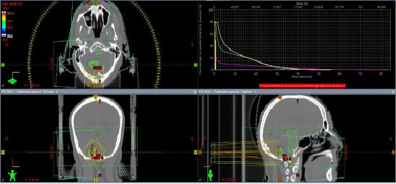 Stereotactic body irradiation for metastasis from renal carcinoma: A retrospective study.