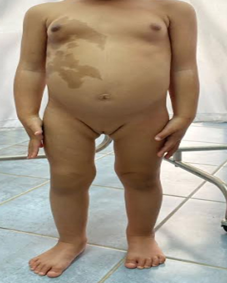 [Precocious puberty in the McCune-Albright Syndrome: a case report].