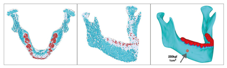 The interaction between third molars and surrounding periapical tissues in mandibular stress distribution during high-impact trauma: a finite element study.