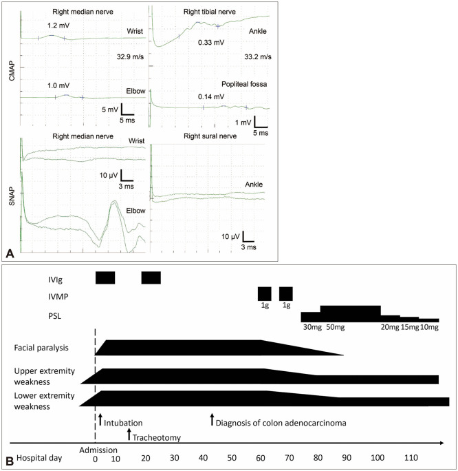 Acute Sensorimotor Neuropathy Associated With Anti-CV2/CRMP5 Antibodies Resembling Guillain-Barré Syndrome.