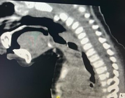 [Impacted subglottic fish vertebra in an infant: an unusual case report].