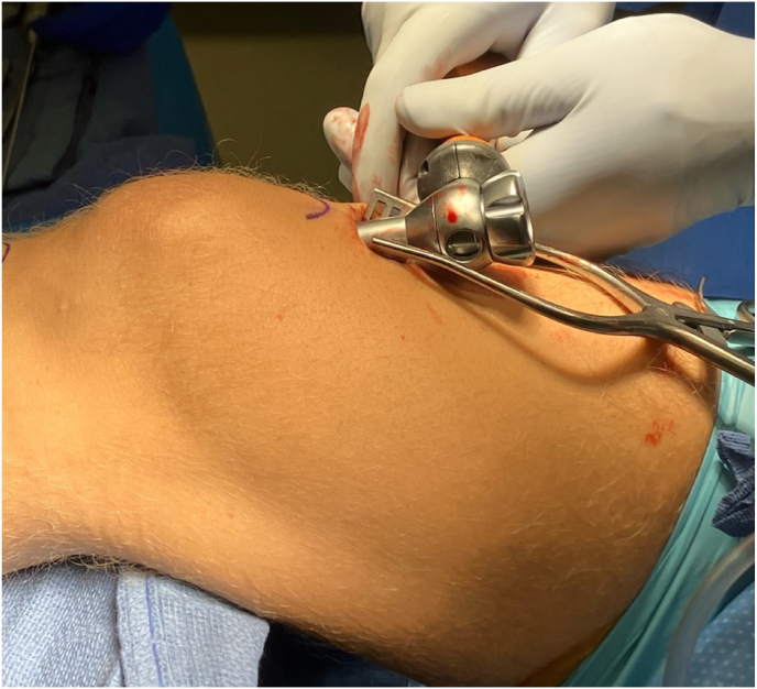 Outcomes of Suprapatellar Intramedullary Nail Fixation of Tibial Shaft Fractures in Skeletally Immature Patients.