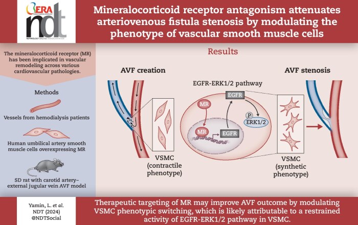 Mineralocorticoid receptor antagonism attenuates arteriovenous fistula stenosis by modulating the phenotype of vascular smooth muscle cells.