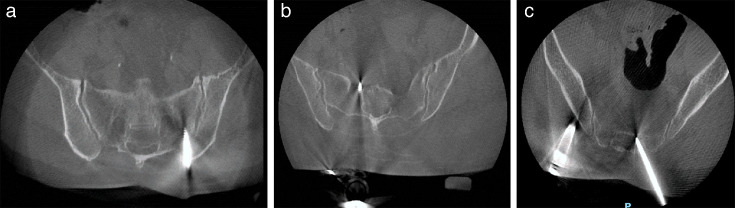 Accuracy of posterosuperior iliac spine reference array placement in robot-navigated spine surgery.