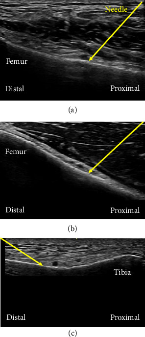 The Role of Genicular Nerve Blocks in Enhancing Postoperative Pain Management After Total Knee Arthroplasty: A Retrospective Study.