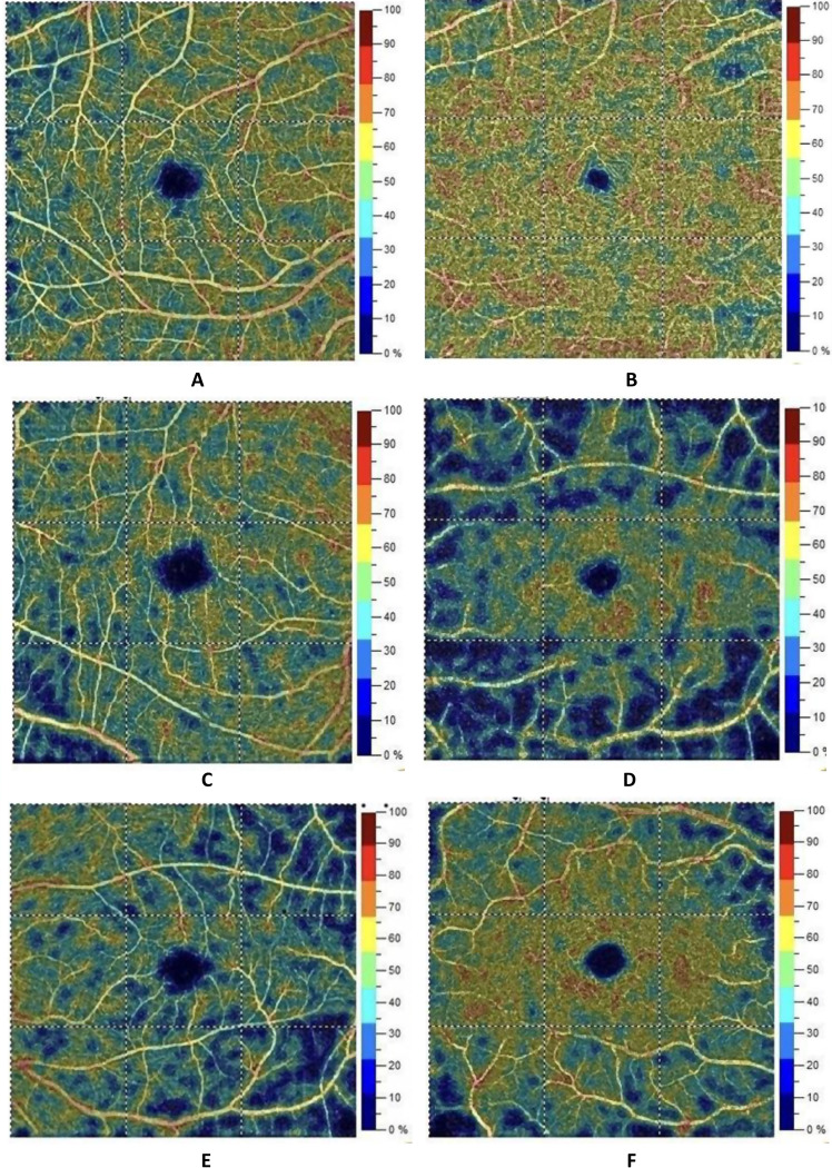 Assessment of retinal microvascular changes in patients with systemic lupus erythematosus using optical coherence tomography angiography.